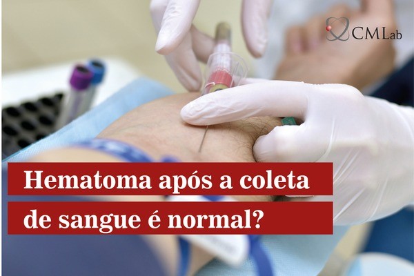 Às vezes, o local da coleta de sangue fica roxo. É normal? Como proceder?